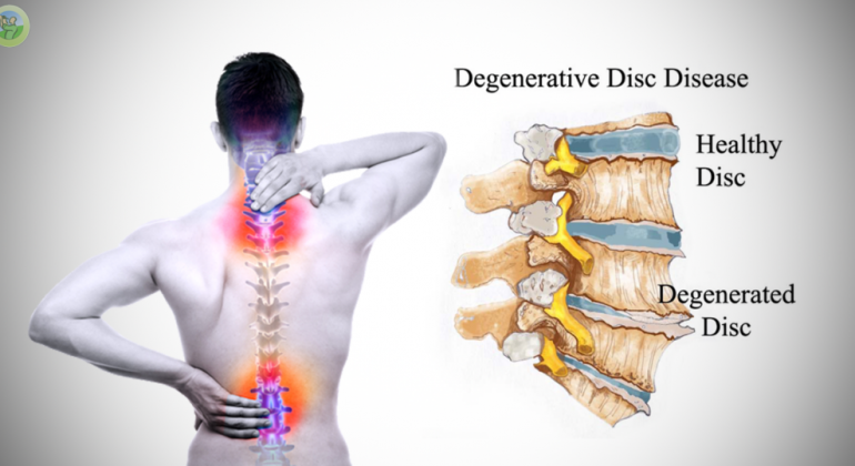 S.G Ayurveda treats Degenerative Disk Disease