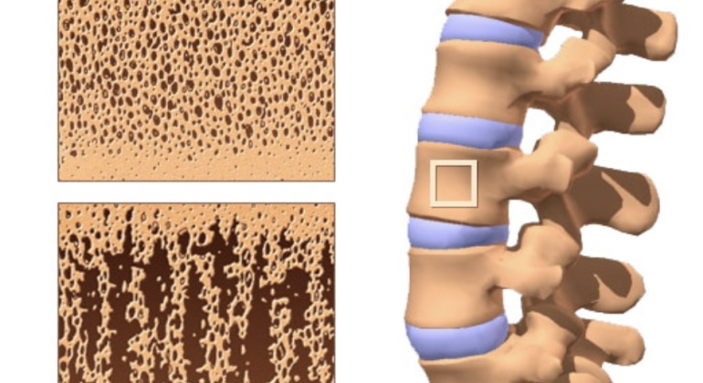 S.G Ayurveda treats Osteoporosis