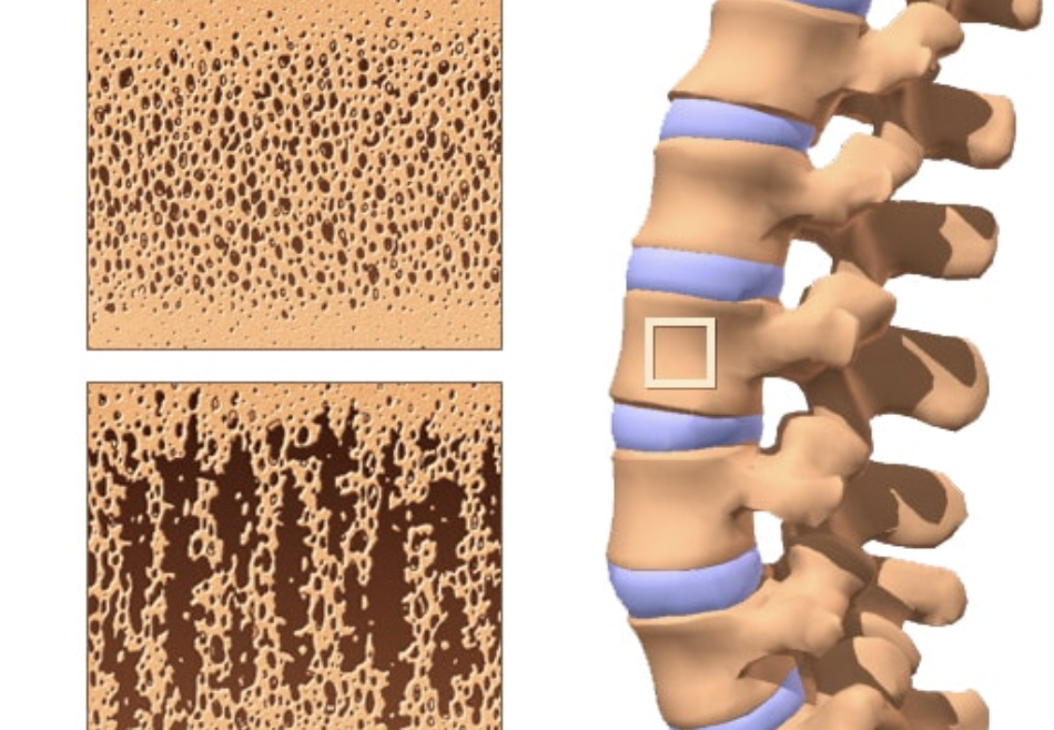 Osteoporosis