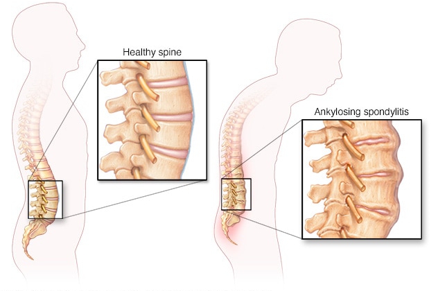 S.G Ayurveda treats ankylosing spondylitis