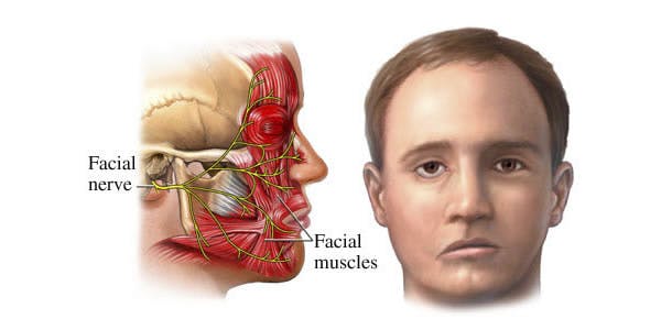 Bell’s Palsy