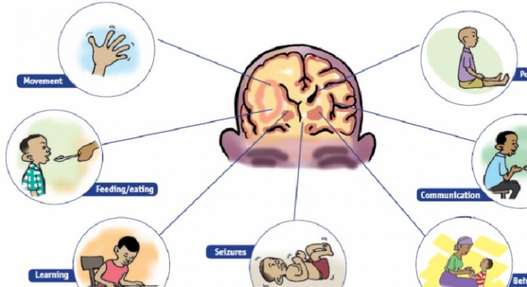 S.G Ayurveda treats cerebral palsy (brain disorder)