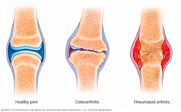 Osteoarthritis