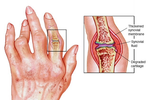 S.G Ayurveda treats rheumatoid arthritis is a chronic inflammatory disorder