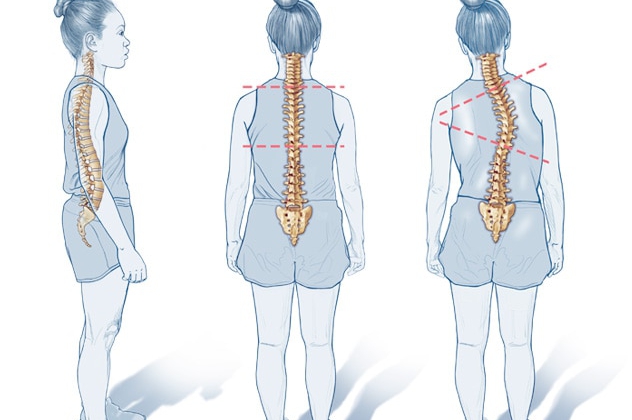 S.G Ayurveda treats scoliosis