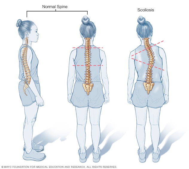 Scoliosis