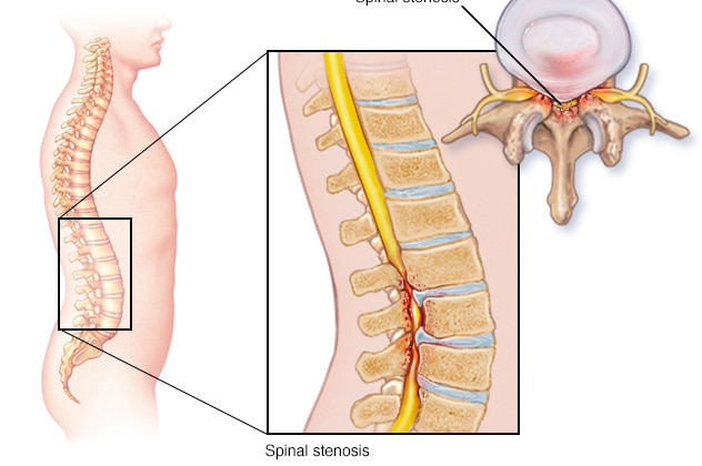 S.G Ayurveda treats spinal stenosis