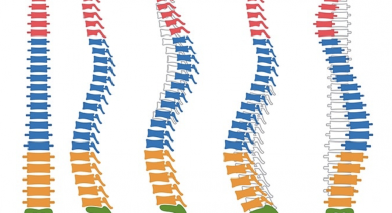 S.G Ayurveda treats spinal deformities