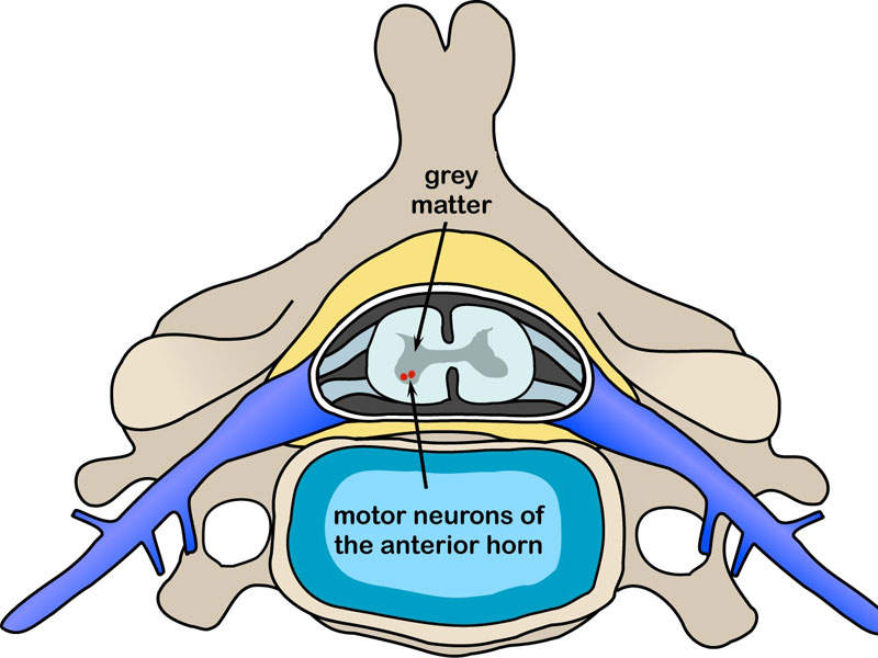 Spinal Muscular Atrophy