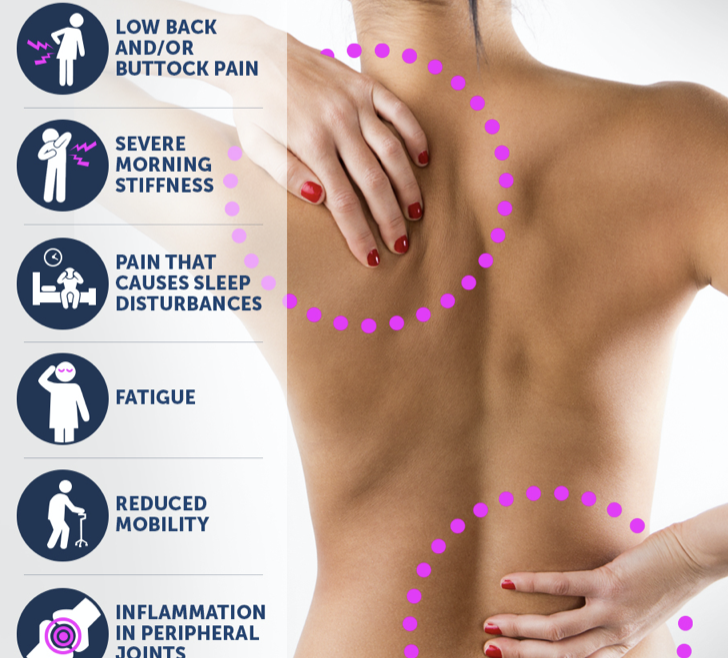 Spondyloarthropathies